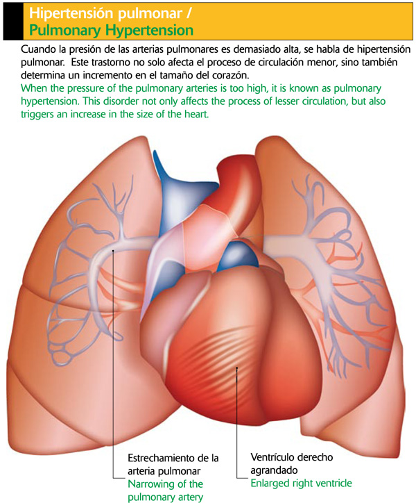 Hipertensión pulmonar