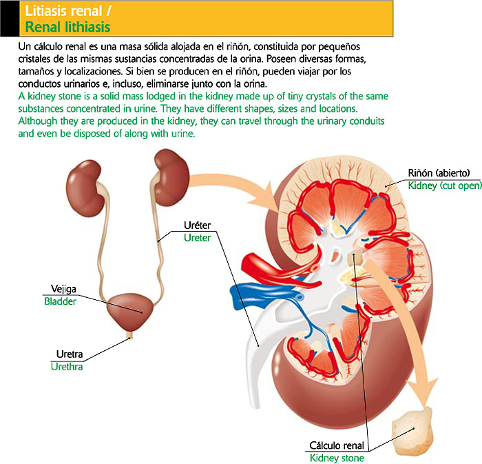 Litiasis renal